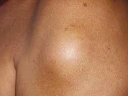 I knew i had a lump under my shoulder blade as in the past i have asked my mum to massage my shoulder and she felt it and could move it under her fingers. Photograph Shows A Lump Over The Left Scapular Region Download Scientific Diagram