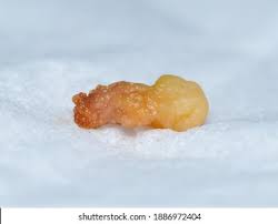 Image result for Tonsillolith