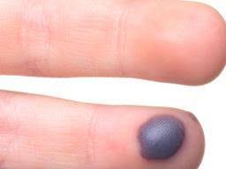A blood blister is filled with blood, rather than serum. Blood Blisters Causes Diagnosis And Treatment