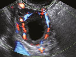 Image result for corpus luteum sonography)