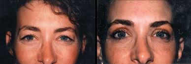 Find funny gifs, cute gifs, reaction gifs and more. Eyelid Surgery Dr Dean Kane Baltimore Maryland