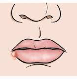 Image result for my 4 year old has a cold sore what treatment can she have