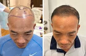 Hình ảnh Nguyễn Đăng Linh Cấy tóc đường chữ M, Cấy tóc tự thân, Điều chỉnh  đường chân tóc 25/08/2025