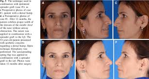 See how spreader grafts can be used to improve internal nasal valve narrowing and treat chronic it is located in the middle third of the nose where the upper lateral cartilages attach to the septum. The Technique Used In Combination With Ipsilateral Spreader Graft Case Download Scientific Diagram