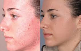 Microdermabrasion Before and After Photos | Derma Laser Center Hollywood Florida | Derma Laser Centers - services-microdermabrasion
