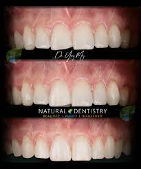 We've rounded up the best attractions for kids in nyc. Best Cosmetic Dentist 1 Smile Makeover Usa Full Mouth Veneers Crowns