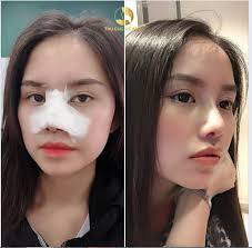 THAY ĐỔI DÁNG MŨI THẤP MẤT LỘC