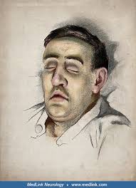 Neurologic disorders related to chemical warfare nerve agents