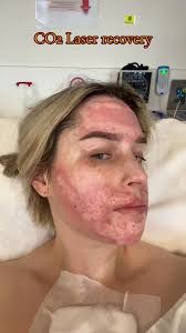 This was taken over 3 weeks. My chest is still a bit red & I’m having some  really strong itchy spots still but otherwise