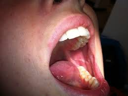 It was discovered that majority of the fibromas. Common Mucosal Findings Smiles For Life Oral Health