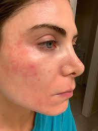 Image result for demodex rosacea