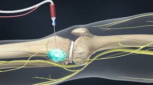 Image result for Radiofrequency Surgery