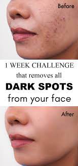1 Week Challenge That Removes All Dark Marks Spots From Your Face Skin Skincaretips Skincarero Skin Spots Anti Aging Skin Products Beauty Skin Care Routine