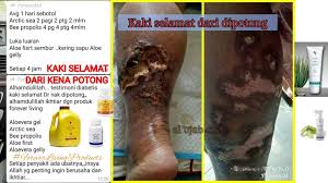 Rawatan kencing manis jenis 2, ubat kencing manis jenis 1, ubat kencing manis janumet, rawatan kencing manis kronik, ubat rawatan yang dijalani pesakit kencing manis ini pada umumnya bertolak belakang dengan harapan, bukan kesembuhan yang didapati, tetapi penderitaan. Luka Kencing Manis Di Kaki Sembuh Tak Jadi Dipotong Ohcantik Com