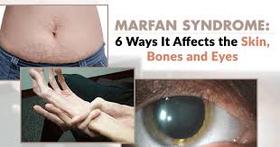 Marfan Syndrome 6 Ways It Affects The Skin Bones And Eyes April 9 2016
