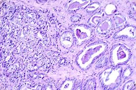Cancer cells are normal cells whose genes have been damaged which cause the cell to respond differently normal cells, however, do not generally transform into cancer cells within a few days. Cancer Cells Characteristics Vs Normal Cells Types And Microscopy