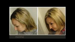 Biotin Hair Growth Before And After Biotin Hair Growth Results Before And After Biotin Hair Growth Results Biotin Hair Growth Healthy Hair Tips
