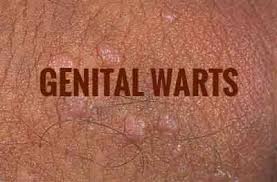 Image result for genital warts
