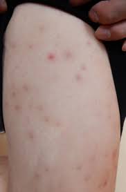 25歲女除腿毛！冒「整排紅點」 醫示警：超過5天沒好快就醫| ETtoday健康雲| ETtoday新聞雲