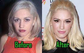 When looking at pictures of her back then and now, she looks a lot different than when she was the lead singer of no doubt. Gwen Stefani Plastic Surgery Facelift Nose Job Before After Celebritysurgeryicon