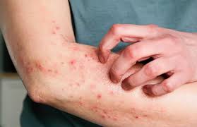Image result for scabies symptoms