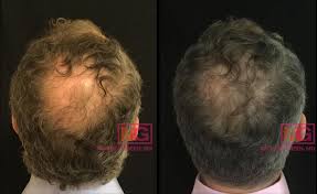 Blood is drawn from the patient being treated for hair loss it is spun in a centrifuge to separate the platelets and plasma it is injected by a physician into the scalp in the area of hair loss to help repair blood vessels, promote cell growth and wound healing, and stimulate collagen production. Male Hair Loss Male Pattern Baldness Prp Hair Treatment Nyc