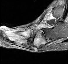 Muscles of the foot muscle origin insertion nerve supply extensor digitorum brevis distal part of the lateral and superior surfaces of the calcaneus and the apex of the inferior extensor. Mri Of The Diabetic Foot Radsource