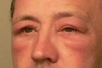 Anaphylaxis happens when you have an antibody, something that usually fights infection, that overreacts anaphylactic reactions usually start within minutes of contact with the trigger, but they. Anaphylaxis Awareness Indi Skills