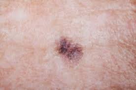 Of course, your specialist is the main person whose advice you should follow but it doesn't do anyone harm. Skin Cancer Plainsboro Nj
