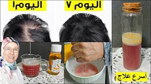 عندك فروة الراس فارغة ومتضررة حضري علاج تساقط الشعر نهائيا خلال اسبوع طب in 2021 thick hair styles drink bottles beautiful flowers