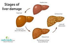 Maybe you would like to learn more about one of these? Hepatic Cirrhosis Causes Symptoms And Treatment