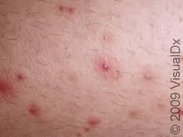Image result for folliculitis symptoms