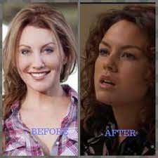 Net worth, son, wedding, children, affair, baby,. Amy Mathews Plastic Surgery Photos Before After Surgery4