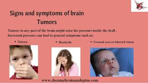 Learn about the signs and symptoms of brain and spinal cord tumors in children. Pediatric Brain Tumor Treatment In Chennai Child Brain Tumor Surger