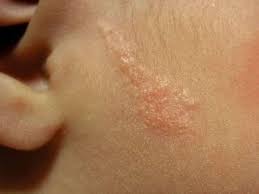 Для него характерны воспаления, покраснения, выраженная сосудистая сетка, наличие папул и пустул, гиперплазия сальных желез и как следствие уплотнение кожи. Foto Vidy Rodimyh Pyaten Vidy Rodimyh Pyaten I Rodinok Rodinki Opasnye I Neopasnye Foto I Opisanie Udalenie Pochemu Poyavlyayutsya Internet Magazin Otlichnoj Mebeli V Tyumeni Magazin Mebeli 72