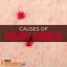 Cherry angiomas comprise of a large number of blood vessels. Cherry Angioma Characteristics Causes Treatment