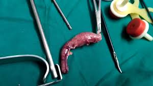 Laparoscopic Appendectomy Surgery - YouTube