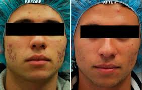 Maybe you would like to learn more about one of these? Fraxel Fractora And Morpheus8 Nyc Best Skin Resurfacing Treatment