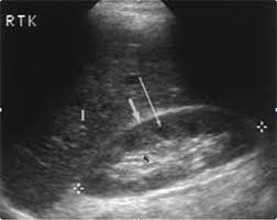 Image result for Nephrolithiasis Imaging