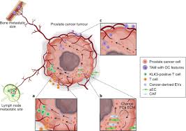 It may feel like a. Prostate Cancer Hijacks The Microenvironment Nature Cell Biology
