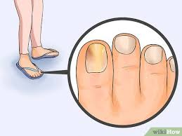 We did not find results for: How To Get Rid Of Toe Fungus 11 Steps With Pictures Wikihow