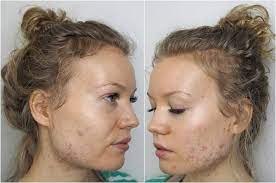 Since birth control pills help balance your hormones throughout your cycle, they can help get wacky periods back on track. Acne Archives Page 2 Of 10 Charlotta Eve