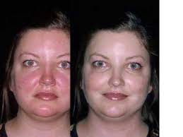 If you have questions about what you might be able to expect with soolantra use, talk with your doctor. Adult Rosacea Before After Treatment Youtube