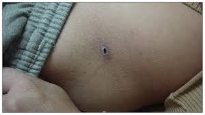 It is caused by a burn or cauterization (destroying tissue with heat or cold, or another method). Eschar A Clue To Scrub Typhus Cmaj