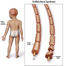 The symptoms may develop over hours to a. Sindrome Guillain Barre Guillain Barre Syndrome Aromatherapy Health Barre