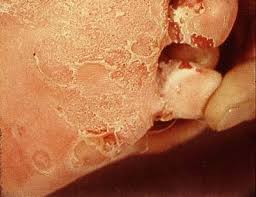 Image result for Tinnea vesiculosa