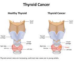 3 take a sip of water. Monitoring For Thyroid Cancer Recurrence