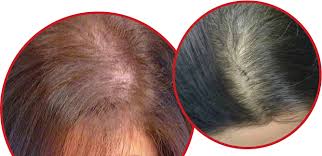 Female pattern hair loss is the most common type of hair loss women experience. Women Hair Loss Treatment In Chennai Female Pattern Baldness Dermaclinix