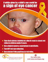 A little boy had to have his eye removed just days after christmas when his parents discovered a rare cancer sign in an innocent photograph. How Do We Achieve Early Diagnosis Of Retinoblastoma We C Hope