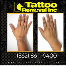 Celebs who get inked warning slightly nsfw images ahead all seeing as cent tattoo removal at least he has a new movie cover up tattoo and harmful. Best Tattoo Removal Los Angeles Tattoos Remove